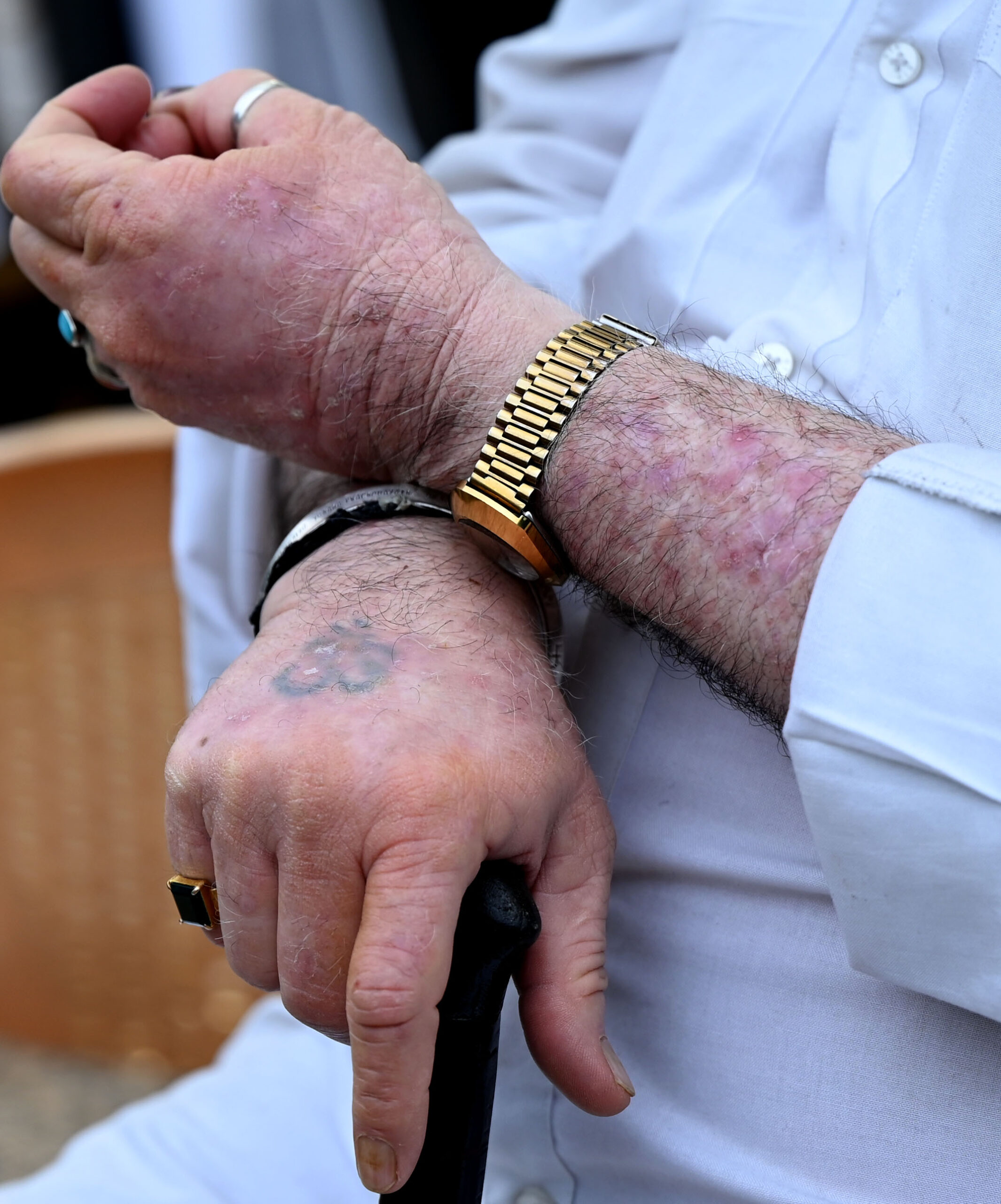 Psoriasis Disease Causes Symptoms Treatment Happiest Health Psoriasis Disease Causes Symptoms Treatment Happiest Health
