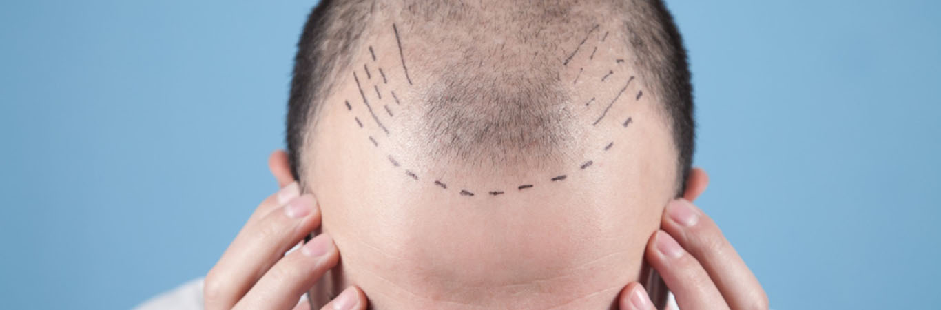 Causes Of Hair Loss Find Out The Hair Fall Reasons In Male Happiest 