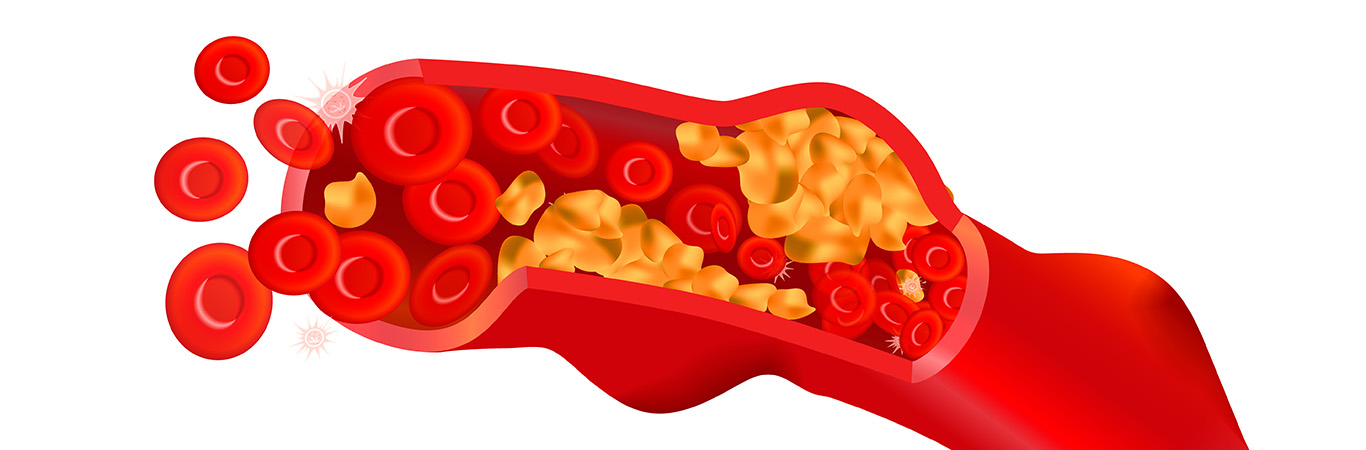 Lipoprotein Current Heart Lipoprotein(a)